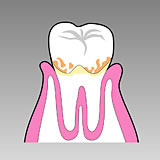 歯肉炎または軽度の歯周炎
